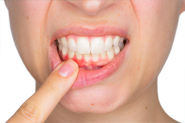Gum Recession Treatment in Roselle