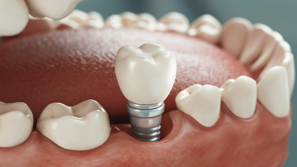 Dental Implants Roselle, NJ or Scotch Plains, NJ